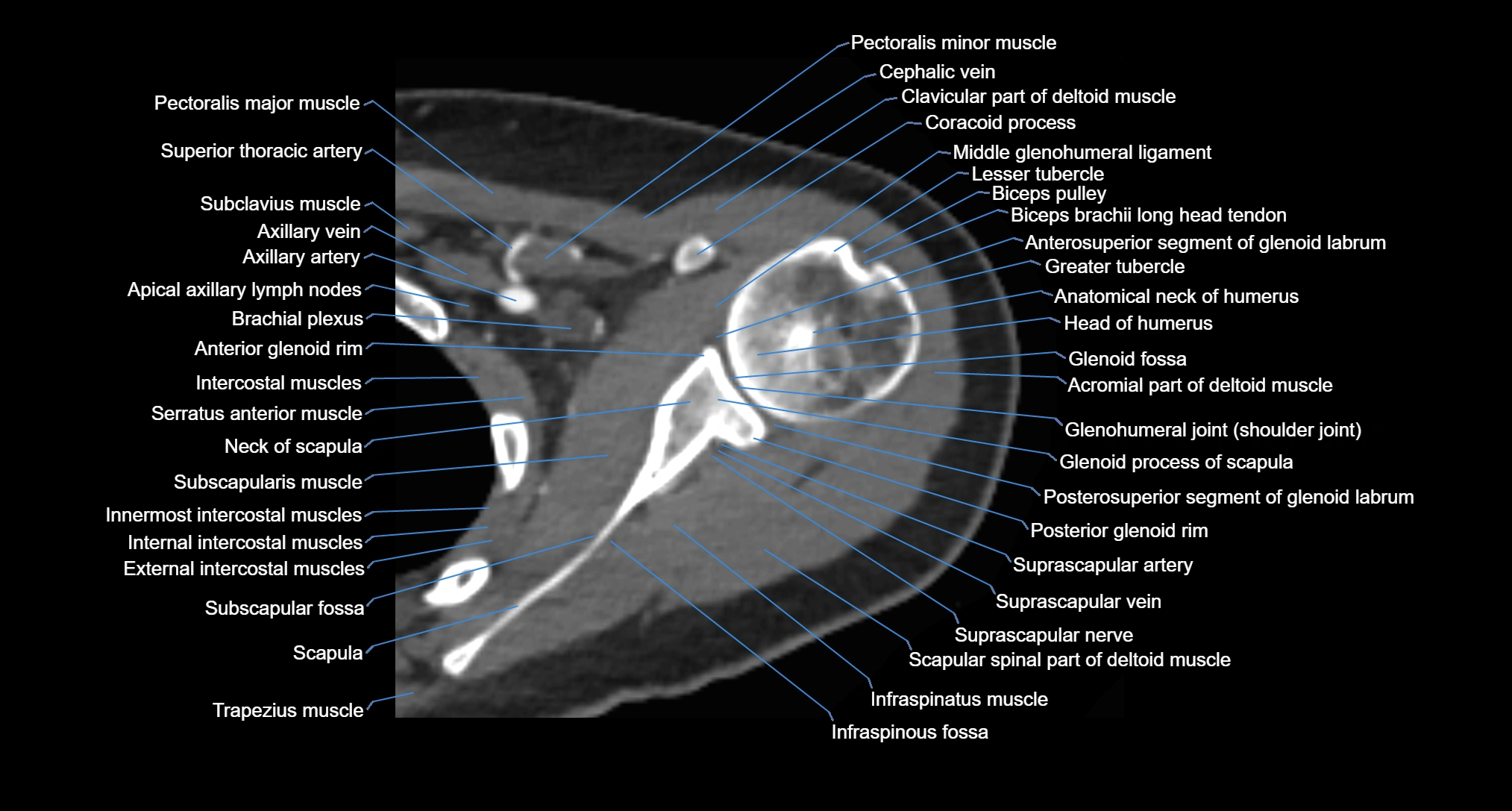CT Shoulder axial cross sectional anatomy labelled radiology image -00031.webp